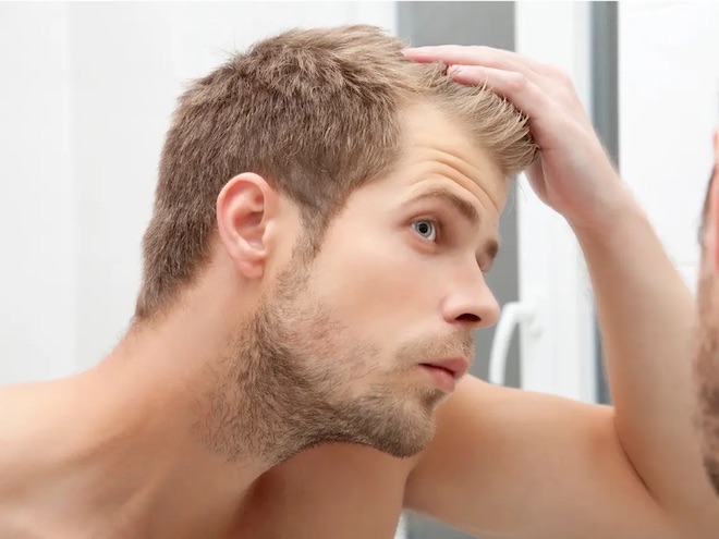 Hói đầu sớm ở nam giới có phải là bệnh
