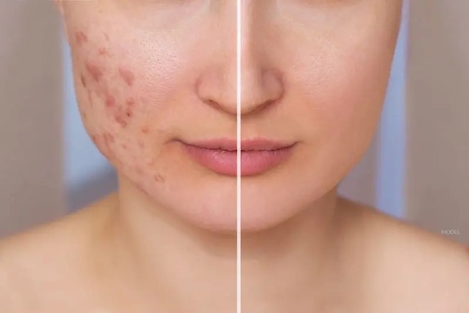 Có cách chăm sóc da sau khi nặn mụn chuẩn sẽ giúp lấy lại nền da khoẻ nhanh hơn